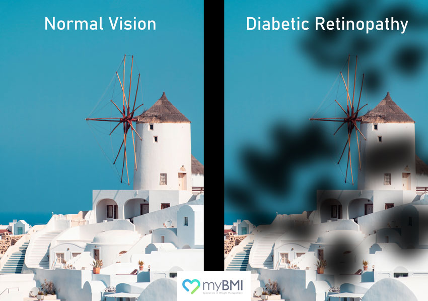 ozempic and diabetic retinopathy